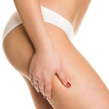 La celulitis es uno de los problemas estéticos que más preocupa