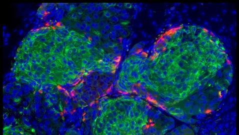 trasplante de células pancreáticas para diabetes
