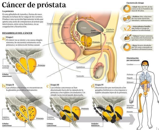 Cancer de prostata en jovenes - Cancer orofaringian hpv