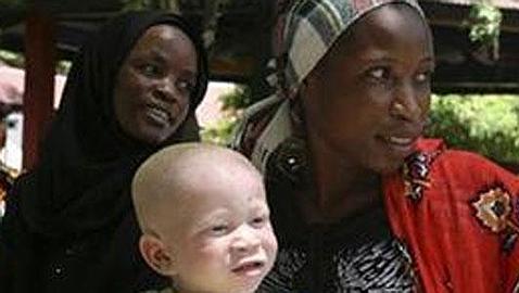 Arrestan en Tanzania a un hombre que intentaba vender a un albino
