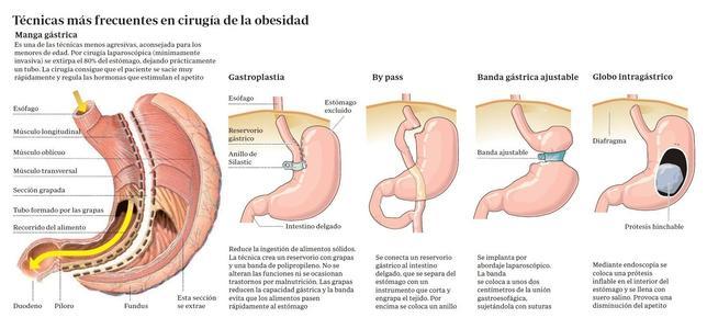 La Paz Reduce El Estomago A Una Nina De 15 Anos Y 120 Kilos De Peso