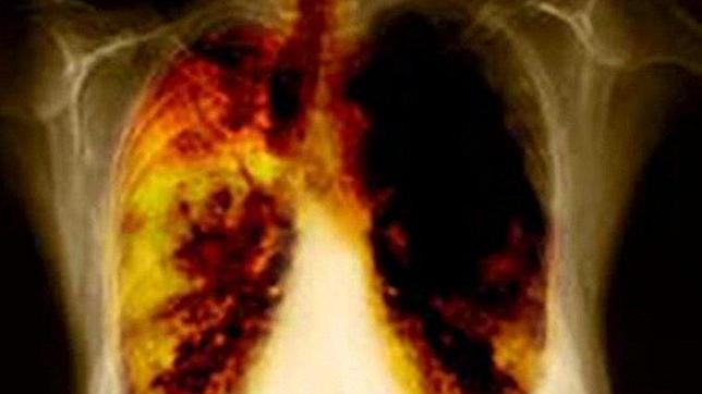 El cáncer de pulmón aumenta entre las mujeres españolas casi un 50%