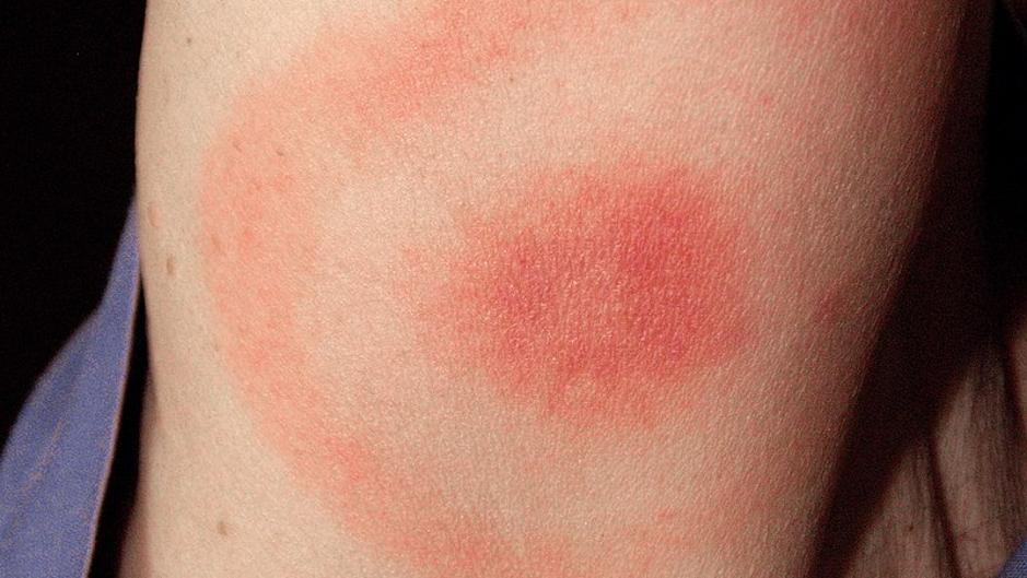 En sintomas enfermedad lyme humanos de