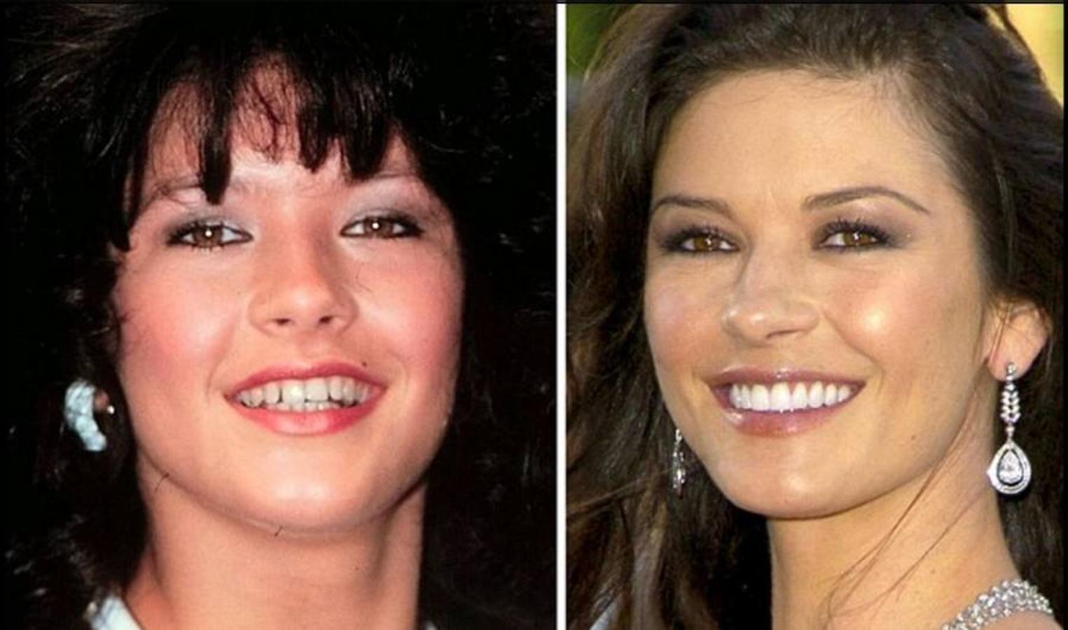 La importancia de una buena sonrisa. El antes y el después de los famosos