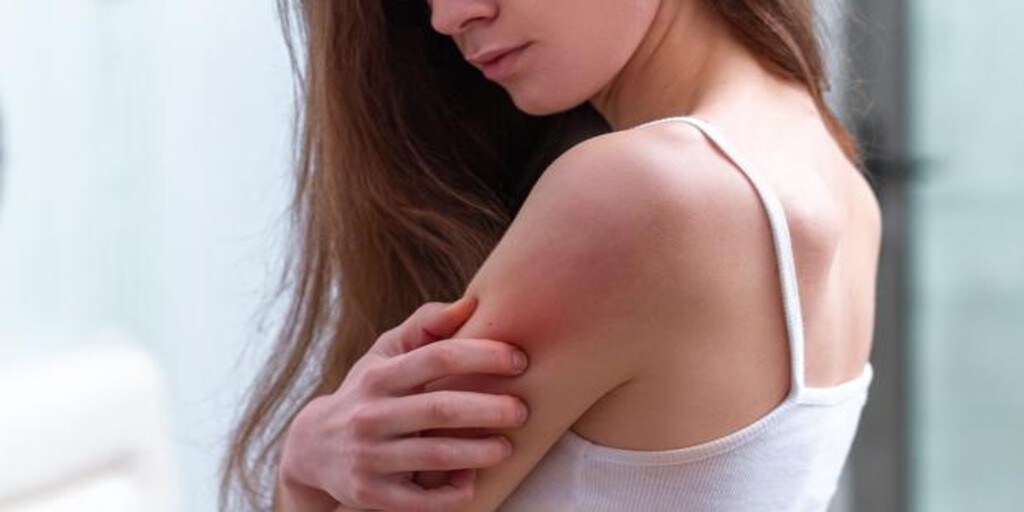 Irritaciones en la piel: por qué se producen en verano y cómo calmarlas