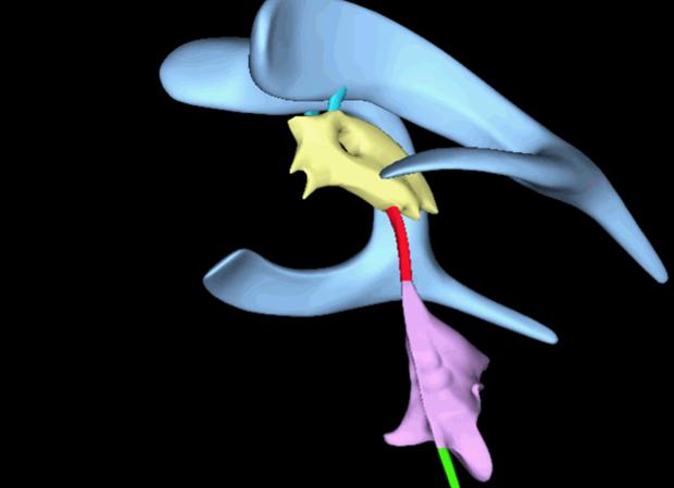 Demasiado líquido cefalorraquídeo en el cerebro Demasiado líquido cefalorraquídeo en el cerebro