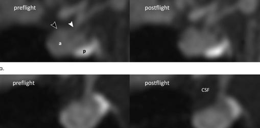 Cambios en la glándula pituitaria de dos atronautas (arriba y abajo)