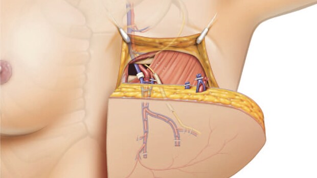 Una Nueva Tecnica Permite Recuperar La Sensibilidad En Las Mamas Reconstruidas Tras Un Cancer