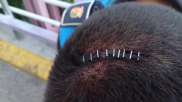 Uno de los agentes heridos en Getafe muestra una de las heridas que le produjeron en la cabeza