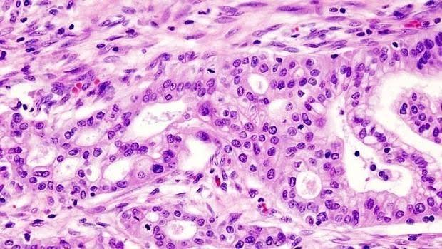 Imagen de un adenocarcinoma ductal de páncreas
