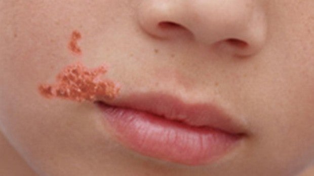 bacterias en la piel de los niños