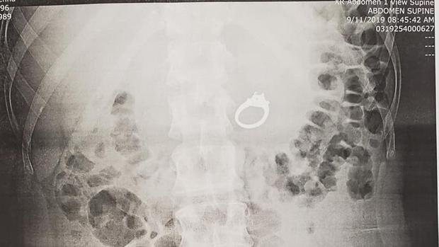 Radiografía que muestra el anillo en el interior de Evans