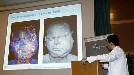 Imagen de la reconstrucción de la cara del paciente en el Hospital Vall D´Hebron, Barcelona EFE