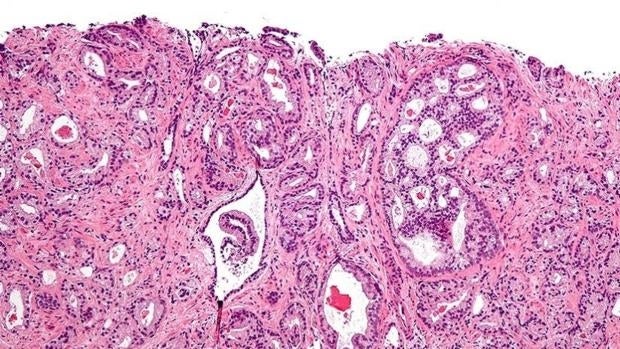 Cáncer de prostata