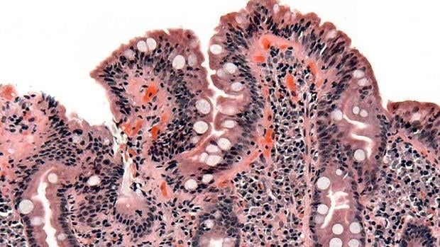 cuales son los síntomas de una enfermedad celiaca cuales son los síntomas de una enfermedad celiaca