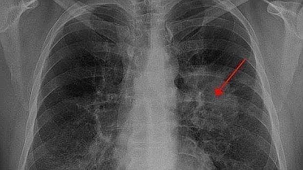 cáncer de próstata de colesterol cáncer de próstata de colesterol