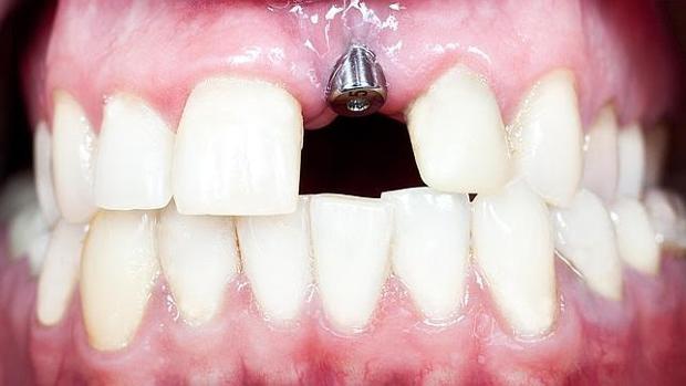 España es uno de los países de la UE en los que se llevan a cabo más implantes dentales