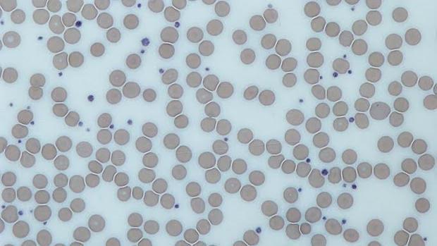 Numero alto de plaquetas en sangre
