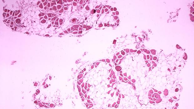 Distrofia muscular de Duchenne