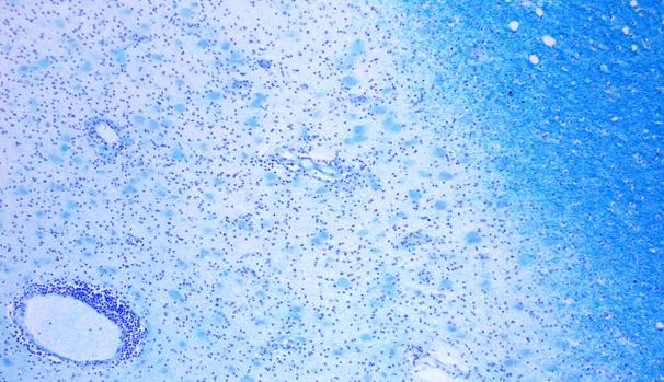 Neuronas desmielinizadas