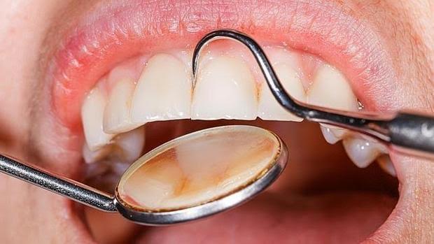 imágenes reales de cáncer de próstata imágenes reales de cáncer de próstata