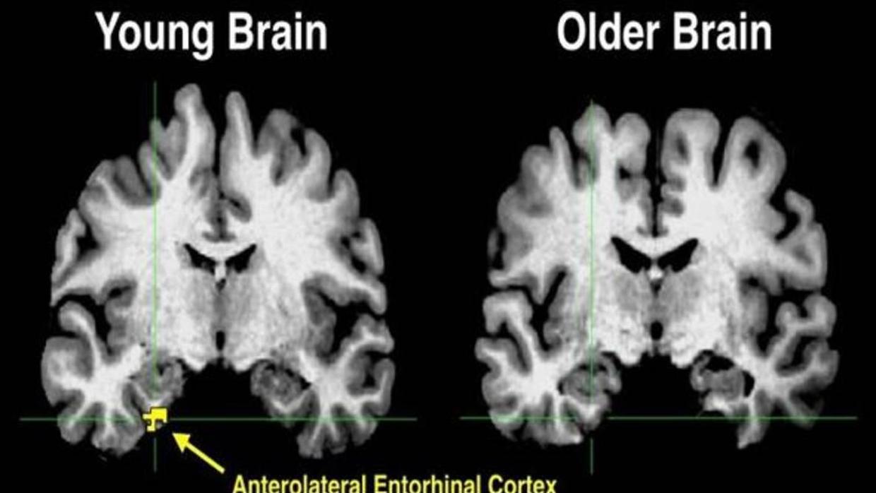 prueba para detectar alzheimer