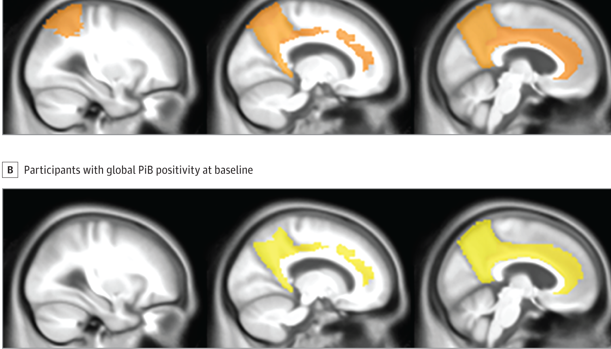 Acúmulo de proteína beta en los cerebros de los pacientes