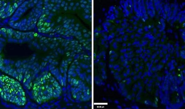 tratamiento más común para el cáncer de próstata tratamiento más común para el cáncer de próstata