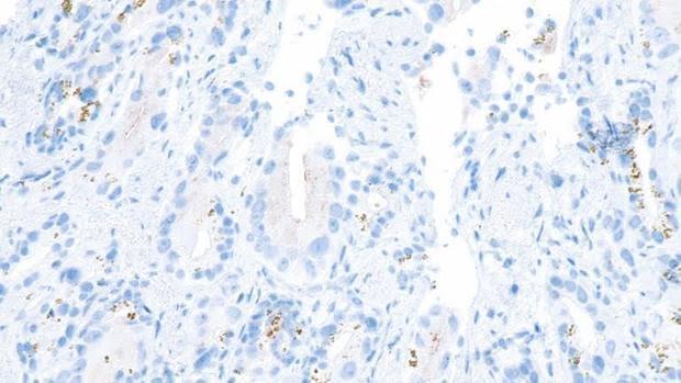 terapia génica para el cáncer de próstata avanzado