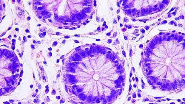 Cancer de colon con metastasis en higado y pulmon supervivencia