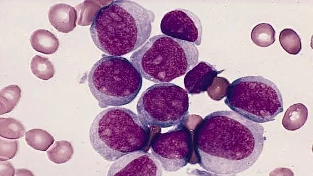 Resultado de imagen para leucemia mieloide aguda