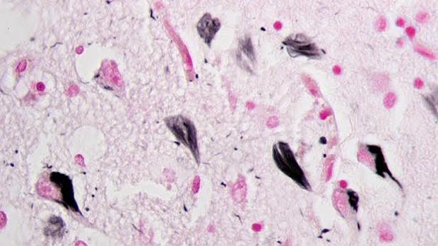 Ovillos neurofibrilares de proteína tau en el hipocampo de un paciente con alzhéimer