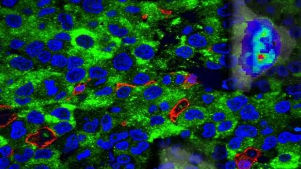 La expresión de AMPK (en verde) es muy elevada en el glioblastoma
