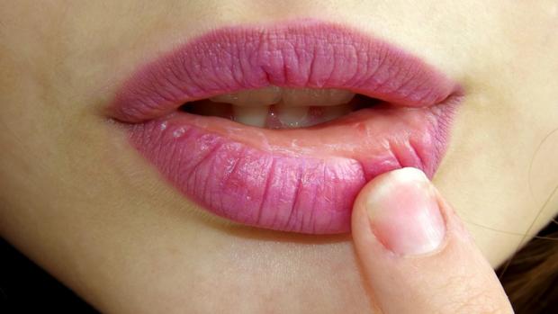 Causas de las herpes labiales