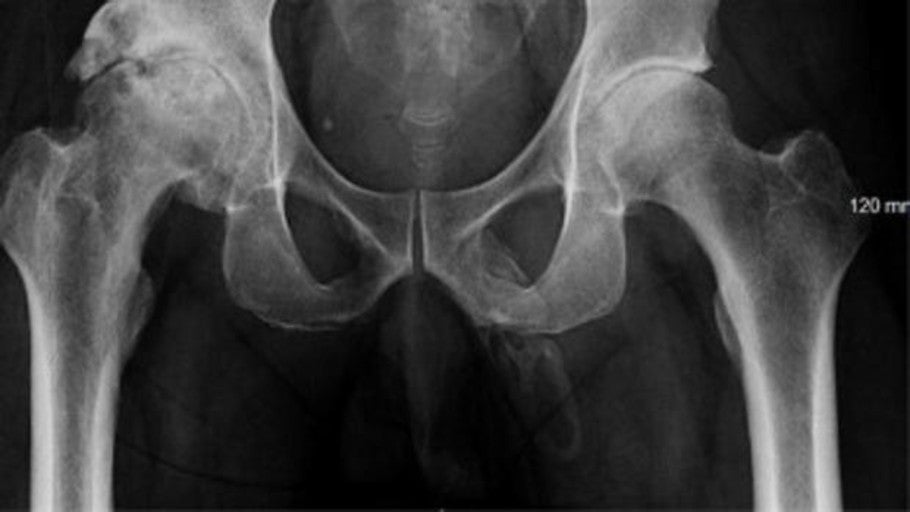 Descubre en una radiografía que su pene se está convirtiendo en hueso