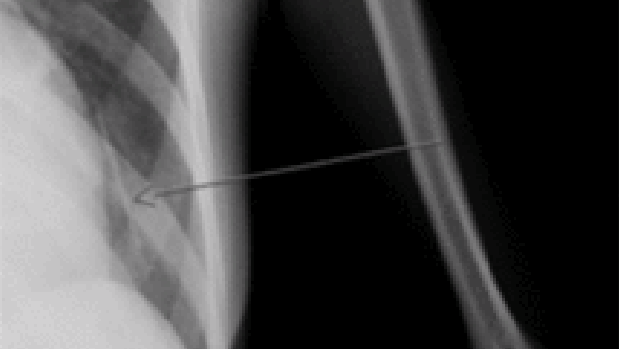 Radiografía de tórax que muestra la ubicación del implante en el lóbulo inferior del pulmón izquierdo (flecha)