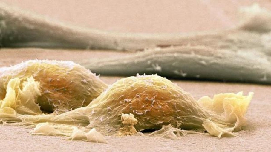 Sarcoma: Estos son los síntomas del cáncer raro que afecta sobre todo a niños y jóvenes
