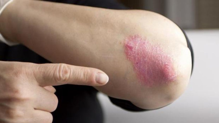 Estos son los síntomas de la psoriasis