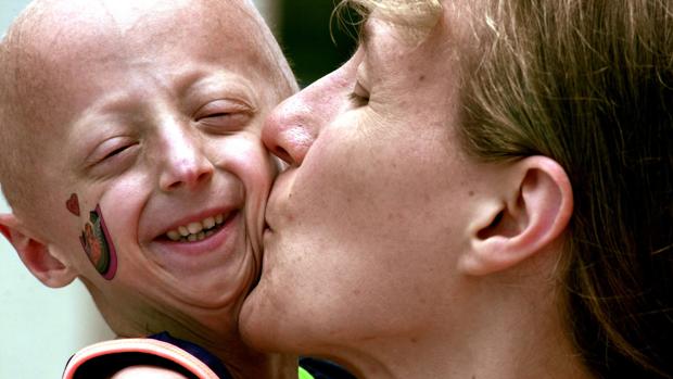 Hallan una nueva estrategia de tratamiento contra la progeria