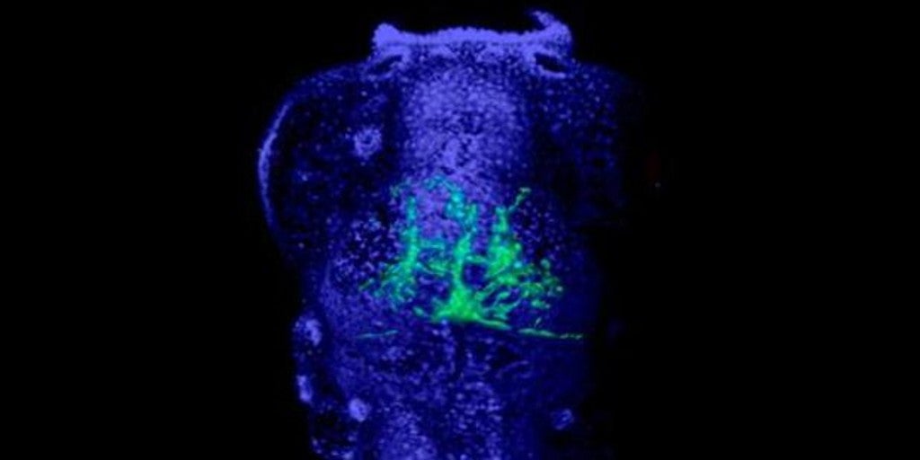 Un algoritmo encuentra un posible tratamiento para un cáncer común en niños