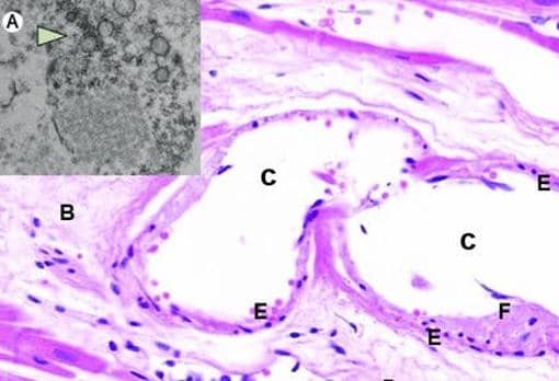 Imágenes de microscopía electrónica de transmisión (A), y microscopía óptica, tinción H&amp;E, de corte histológico de músculo cardíaco (B-H), en paciente con Covid-19 fallecido por infarto de miocardio. El corte procede del músculo cardíaco conservado, no afectado por el infarto. A: detalle de porción citoplásmica de célula endotelial cargada de virus. Los agregados de partículas virales (flecha), se muestran como círculos densos con centro claro. B: estroma conectivo laxo edematoso de músculo cardíaco, con vaso sanguíneo dilatado (C). D: células musculares cardíacas conservadas (cardiomiocitos). E: células endoteliales reactivas que tapizan el vaso, con restos de fibrina adheridos (F), y algunos linfocitos dispersos bajo el endotelio (G). H: hematíes dentro de la luz del vaso. El grado de endotelitis es mínimo, casi imperceptible en microscopía óptica