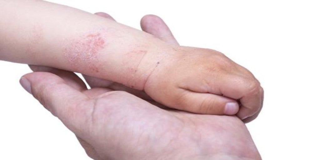 What is the best emollient for atopic dermatitis? TIme News
