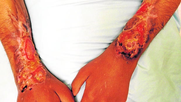La droga «krokodil» pudre hasta los huesos