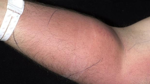 Como colocar una inyeccion intramuscular en el brazo