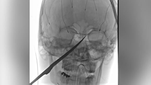 Radiografía que muestra el cuchillo clavado en el rostro de Eli Gregg