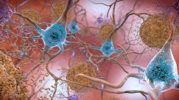Cerebro afectado por Alzhéimers